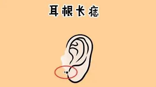 男人耳朵上有痣图解对照表 男人耳朵痣的位置与命运图