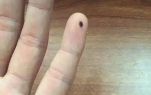 右手小指突然长了颗痣 右手小指有痣代表什么